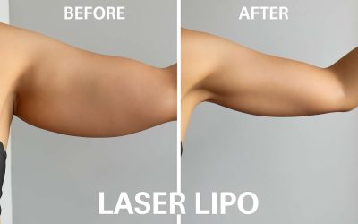 Laser Lipo Arms Before and After: Stunning Transformations That Show Real Results