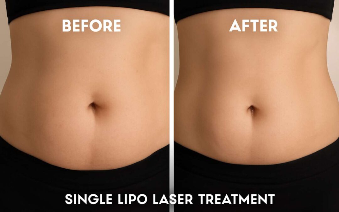 See dramatic lipo laser before and after 1 treatment: real results