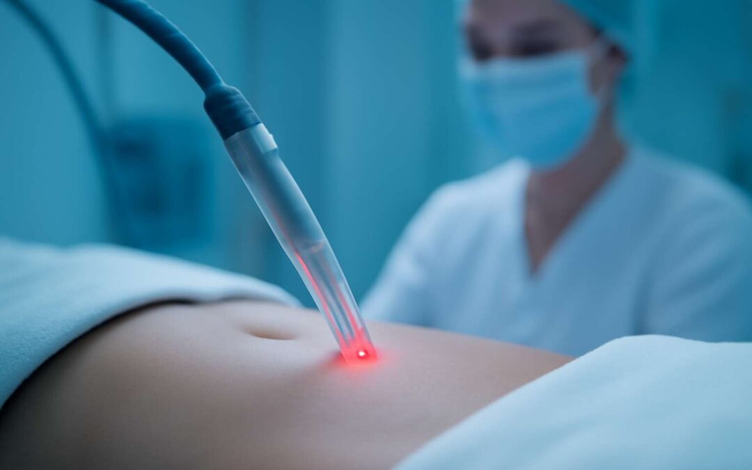 What you should know about laser lipo does it work: real results and risks.